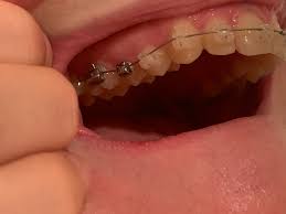 The first type is painless but lasts for a long duration whereas the second type is very painful and lasts for a short want to know how to get rid of gingivitis quickly? Gum Inflammation Details In Comments Braces