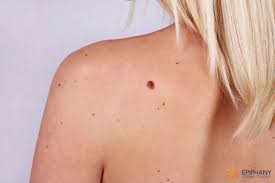 difference between skin s moles