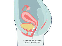 pelvic floor dysfunction and uti