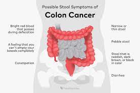 colon cancer stool signs and symptoms