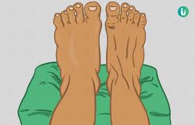swelling in feet symptoms causes