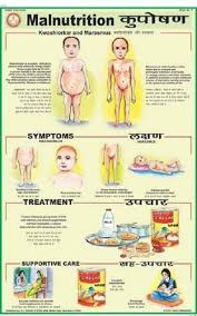 Malnutrition For Health Hygiene Chart
