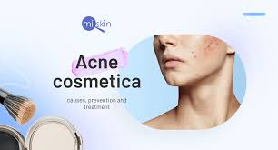 cosmetic acne how to prevent and get