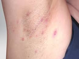 what is hidradenitis suppurativa hs