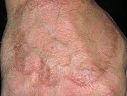 The most common form is localized granuloma annulare, which is characterized by the presence of small, firm red or yellow colored bumps (nodules or papules) that appear arranged in a ring on the skin. Granuloma Annulare Dermnet Nz