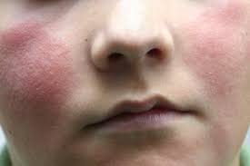 rashes in es and children nhs