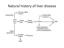 The liver structure becomes abnormal and interferes with liver blood. The Pathogenesis Of Liver Cirrhosis And Fibrosis