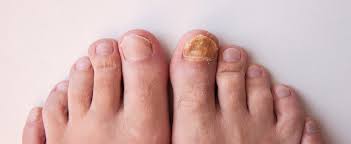 toenail fungus signs symptoms and