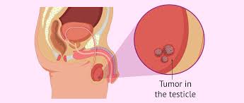 testicular cancer causes symptoms