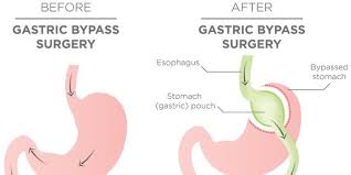 about gastric byp surgery
