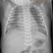 Chests contain items that must be purchased with gold. Infant Respiratory Distress Syndrome Irds Symptoms And Treatment