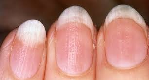 What Your Fingernails Say About Your Health Ridges Spots