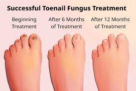 how toenail fungus looks when it s dying