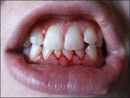 how to treat pyorrhoea bleeding gums