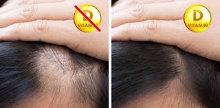 vitamin d deficiency and hair loss
