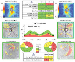 Retinal Nerve Fiber Layer Changes Based On Historic Cd4
