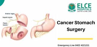Stomach cancer is staged according to how far it has spread at the time of diagnosis. Cancer Stomach Surgery Symptoms Diagnosis Treatment Elce