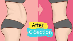 weight loss exercise after c section