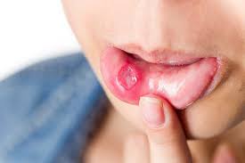 canker sores causes symptoms and
