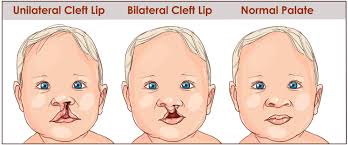 cleft palate causes treatment and
