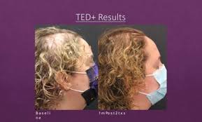 houston hair restoration deals in and