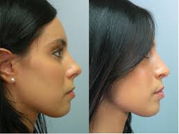 how much does rhinoplasty surgery cost