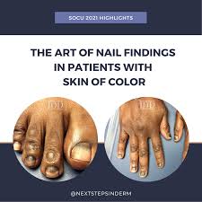 the art of nail findings in patients