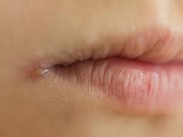 what causes corners of the mouth to