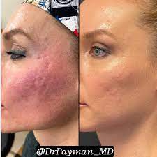 acne scars atlanta ga derm clinic m d