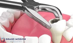 stop bleeding after tooth extraction