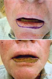 squamous cell carcinoma of the lip
