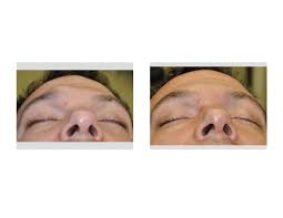 one sided brow bone reduction