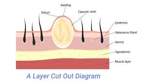 popping a sebaceous cyst can i burst