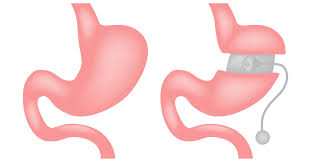 can bariatric surgery be reversed