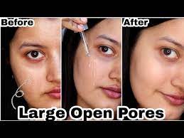open pores