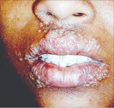 cold sores what you should know the