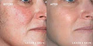 vbeam laser skin pigmentation