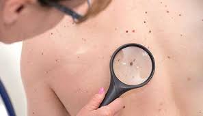 Other Benign Skin Growths Johns Hopkins Medicine
