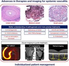 Advances In Therapies And Imaging For Systemic Vasculitis