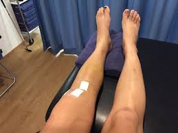 acl surgery recovery phases