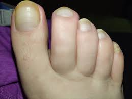 white lines on my toenails mumsnet