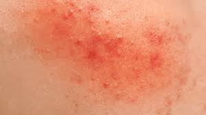 natural remes to treat diaper rashes