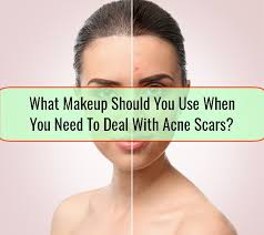 with acne scars