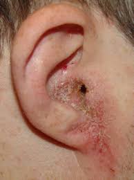 about ois externa swimmers ear