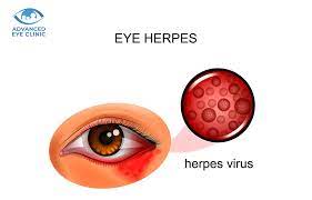 all about eye herpes advanced eye clinic