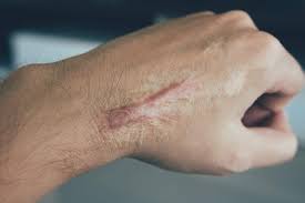 scar removal treatment hand scar