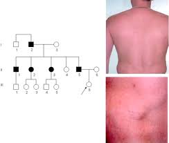 familial multiple lipomatosis with