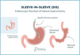 gastric sleeve revision in livingston