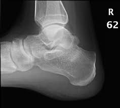 Image result for free images stress fracture. Calcaneus or heel bone stress fracture.