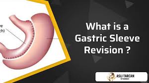 what is a gastric sleeve revision